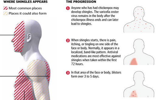 Understanding shingles